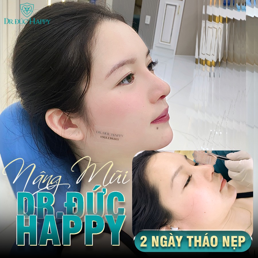 Ứng Dụng Kỹ Thuật Nâng Mũi Dr.Đức Happy 2 Ngày Tháo Nẹp Trong Phẫu Thuật Nâng Mũi 12 nâng mũi vi phẫu 2 ngày tháo nẹp
