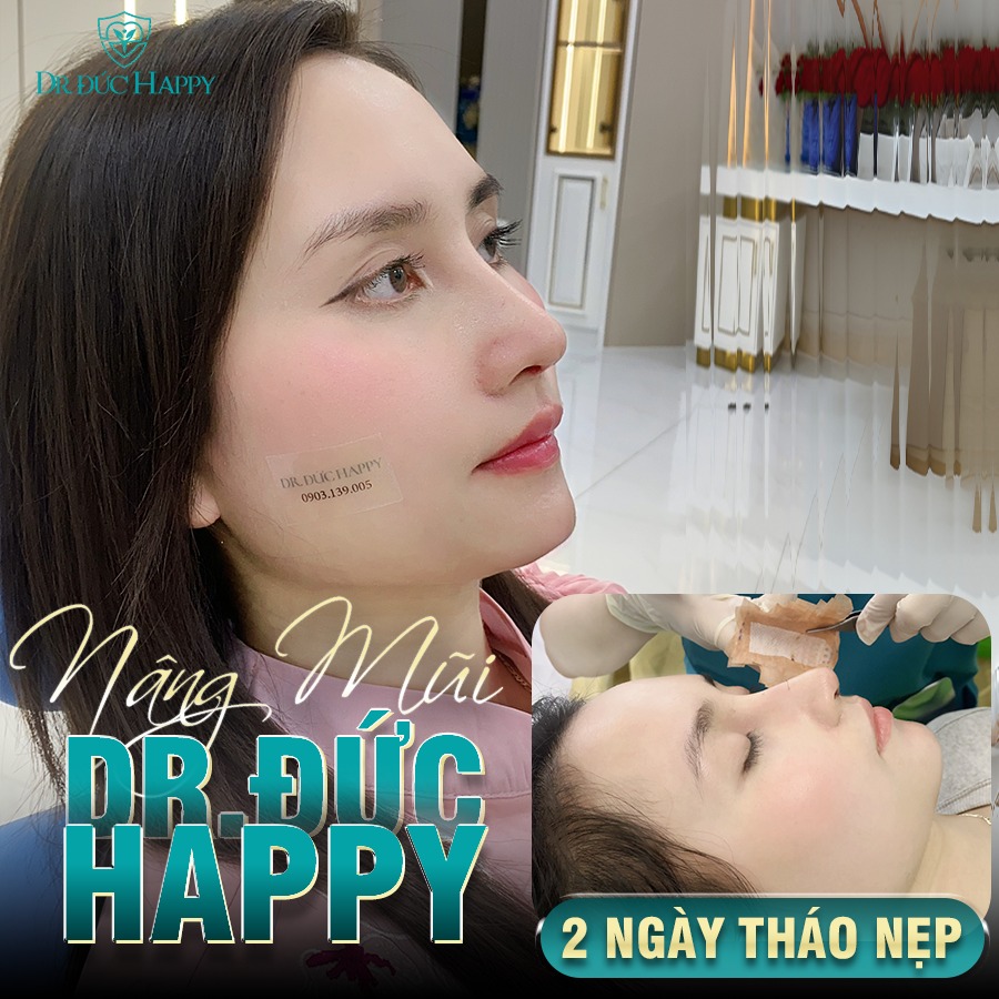 Ứng Dụng Kỹ Thuật Nâng Mũi Dr.Đức Happy 2 Ngày Tháo Nẹp Trong Phẫu Thuật Nâng Mũi 11 nâng mũi vi phẫu 2 ngày tháo nẹp