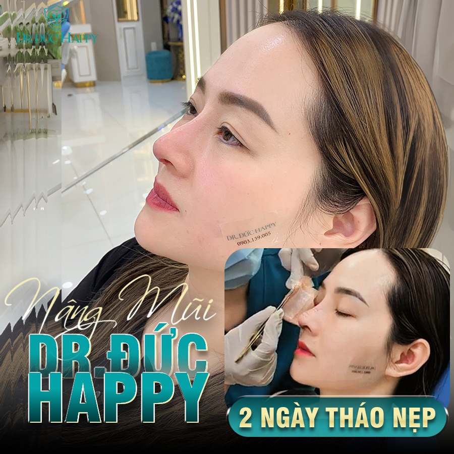 Ứng Dụng Kỹ Thuật Nâng Mũi Dr.Đức Happy 2 Ngày Tháo Nẹp Trong Phẫu Thuật Nâng Mũi 16 nâng mũi vi phẫu 2 ngày tháo nẹp