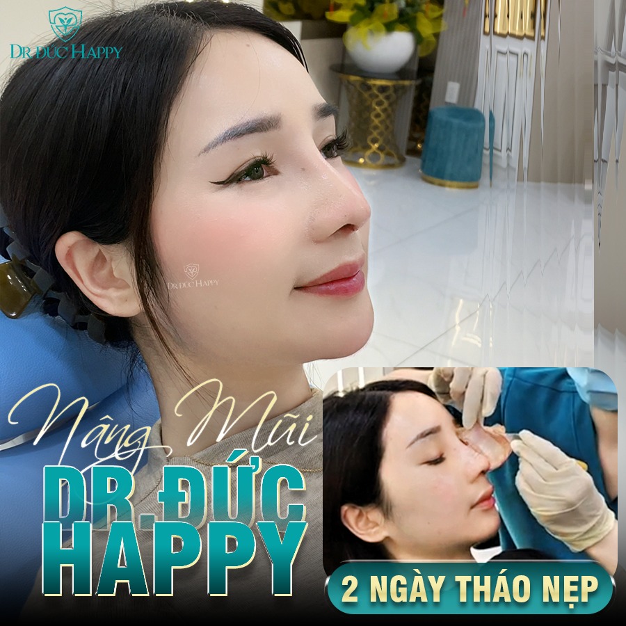 Ứng Dụng Kỹ Thuật Nâng Mũi Dr.Đức Happy 2 Ngày Tháo Nẹp Trong Phẫu Thuật Nâng Mũi 15 nâng mũi vi phẫu 2 ngày tháo nẹp