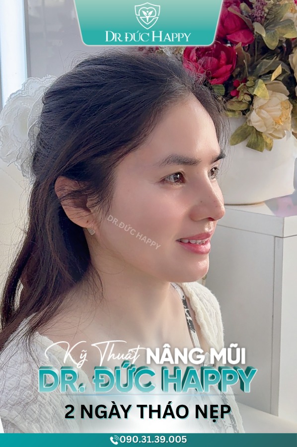 Ứng Dụng Kỹ Thuật Nâng Mũi Dr.Đức Happy 2 Ngày Tháo Nẹp Trong Phẫu Thuật Nâng Mũi 5 Kỹ thuật nâng mũi Dr. Đức Happy - Nâng mũi vi phẫu