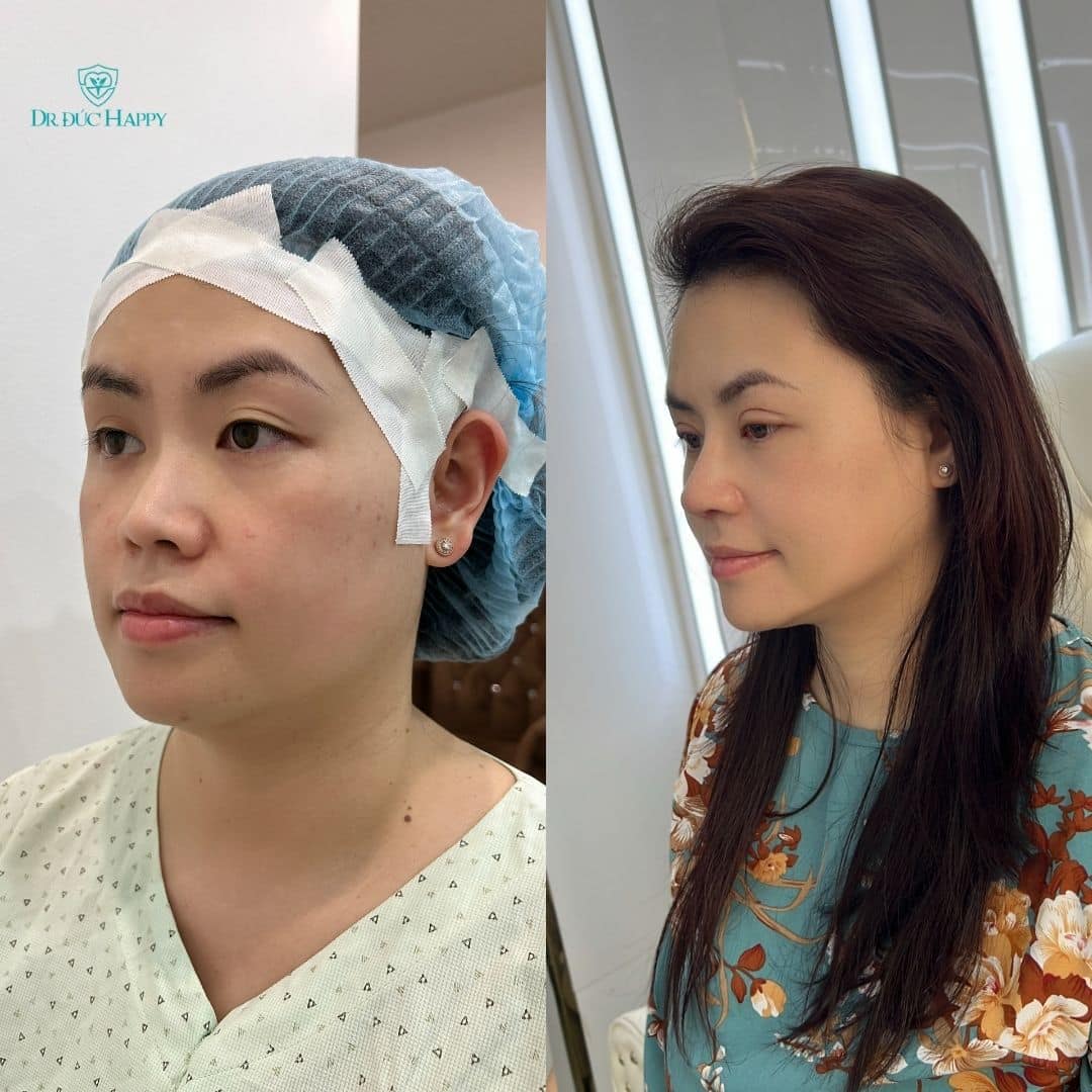 Sửa mũi sụn sườn hỏng: Dấu hiệu, nguyên nhân và cách khắc phục 2 sửa mũi sụn sườn hỏng