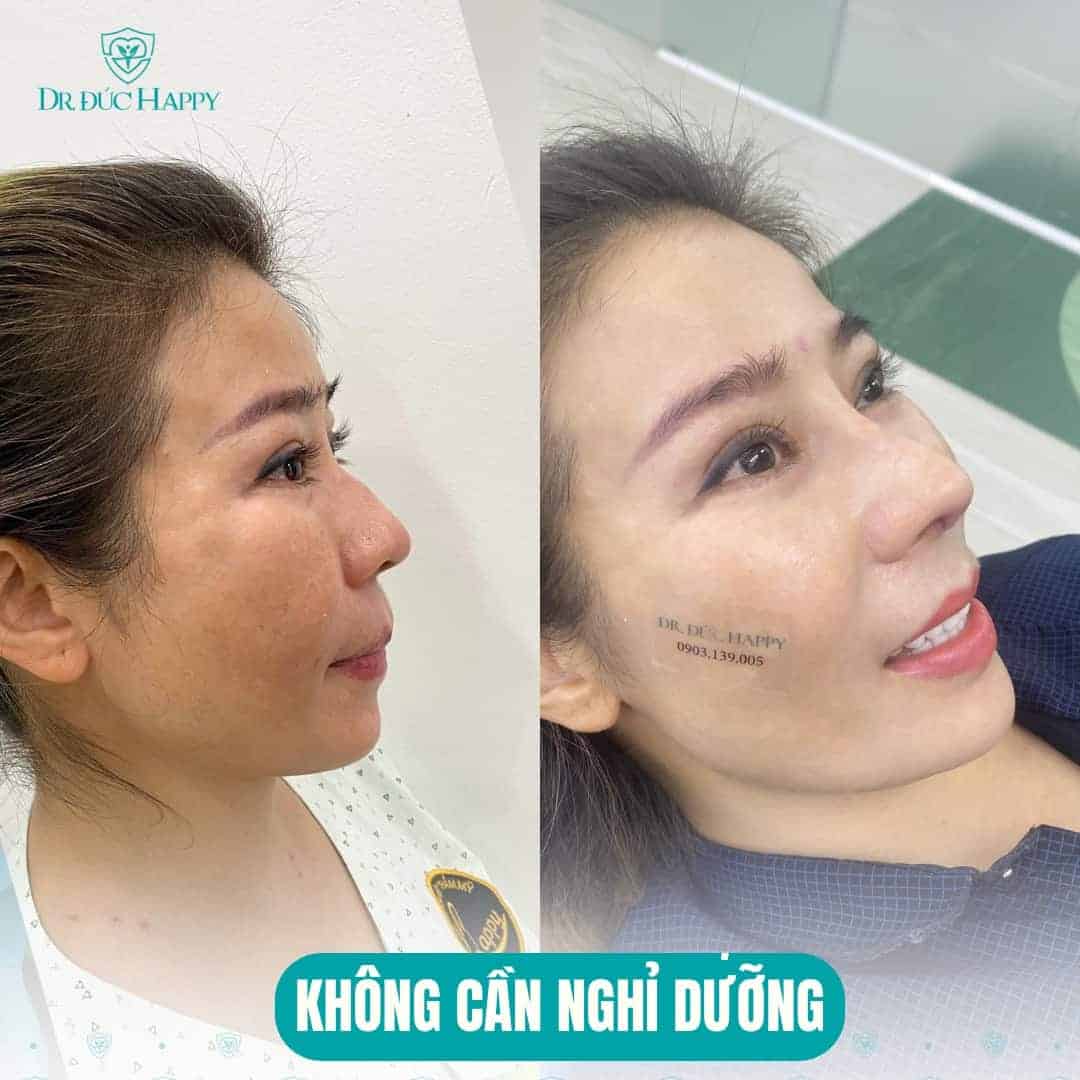 Sửa mũi sụn sườn hỏng: Dấu hiệu, nguyên nhân và cách khắc phục 3 sửa mũi sụn sườn hỏng