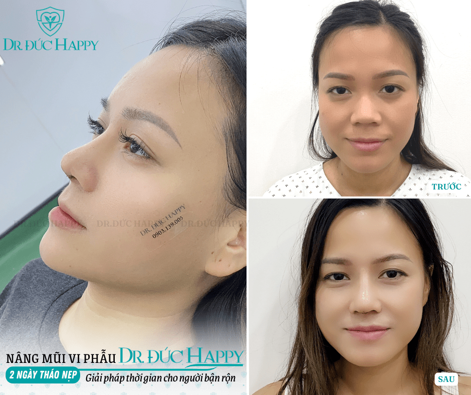 Sửa mũi sụn sườn hỏng: Dấu hiệu, nguyên nhân và cách khắc phục 4 sửa mũi sụn sườn hỏng