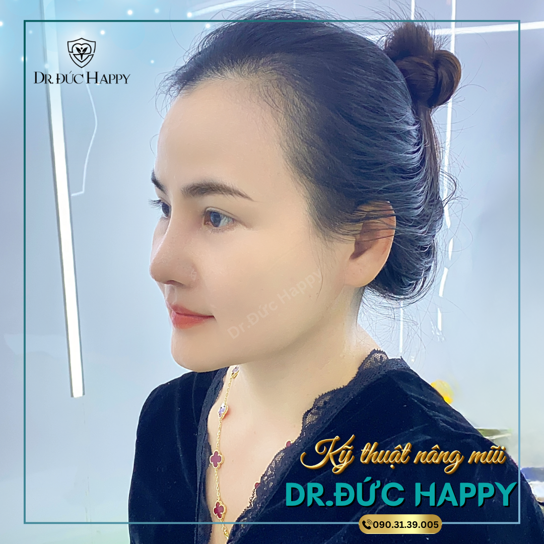 Sửa mũi sụn sườn hỏng: Dấu hiệu, nguyên nhân và cách khắc phục 7 sửa mũi sụn sườn hỏng
